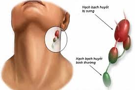 Ung thư vòm mũi là gì? Những điều cần biết về ung thư vòm mũi