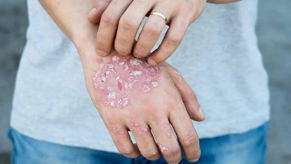 Bệnh chàm da (Eczema): Nguyên nhân, triệu chứng và chẩn đoán