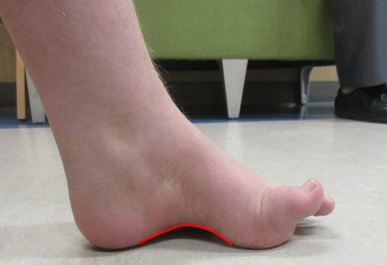 Bệnh Charcot-Marie-Tooth (teo cơ Mác): nguyên nhân, triệu chứng và điều trị