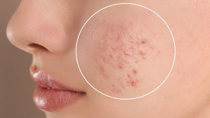 Prolactin cao có gây vô sinh không?