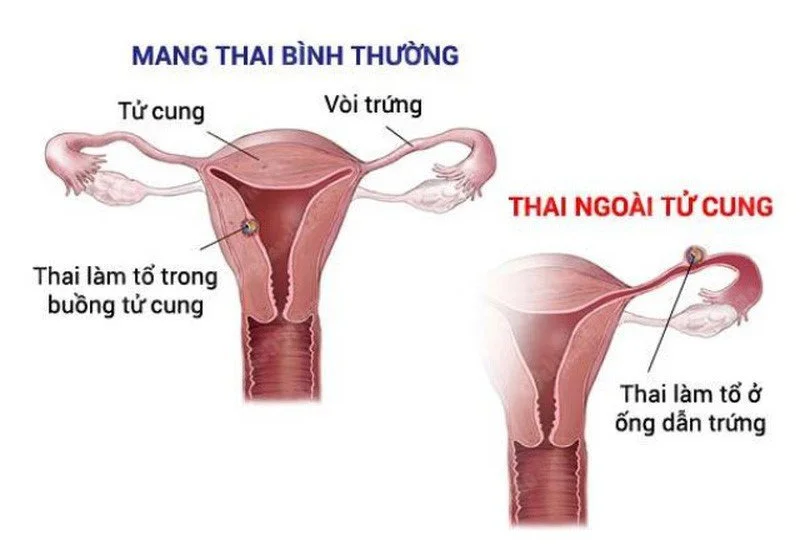 Câu hỏi thường gặp về mang thai ngoài tử cung