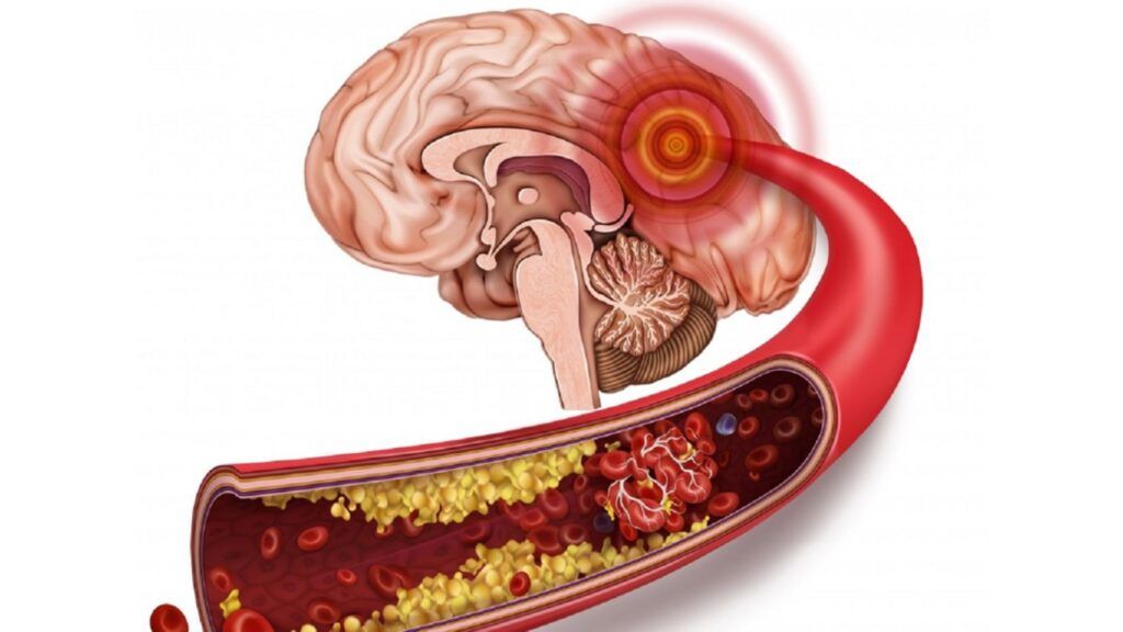 Bệnh tăng tiểu cầu: nguy hiểm hay không?