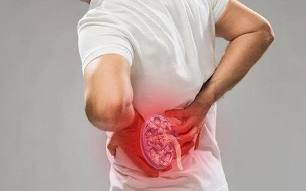 Sỏi dễ tái phát - Điều cần làm sau tán sỏi thận qua da