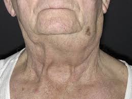 Dấu hiệu nhận biết ung thư hạch sớm