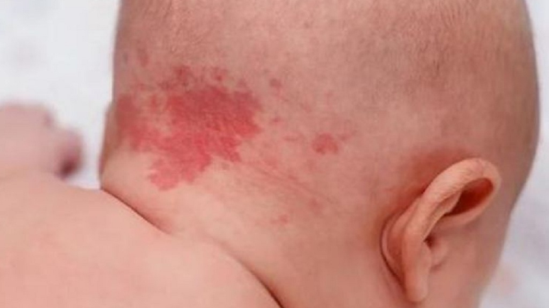 Da mặt trẻ nổi mạch máu: Nguyên nhân và phương pháp xử lý