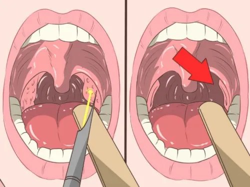 Vì sao vẫn bị hôi miệng dù đã đánh răng thường xuyên?