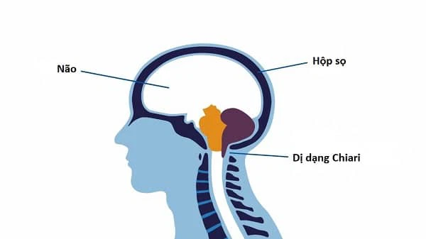 Dị dạng Chiari: Bất thường cấu trúc ảnh hưởng lên hệ thần kinh