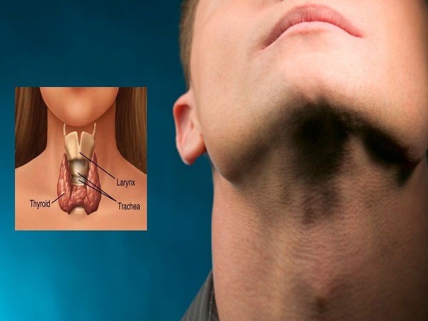 Yếu tố nguy cơ gây ra bệnh ung thư tuyến giáp