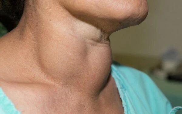 Những sự thật về bướu giáp nhân bạn cần biết