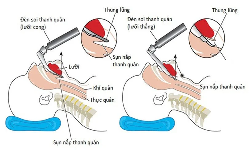 Đặt nội khí quản được chỉ định trong trường hợp nào?