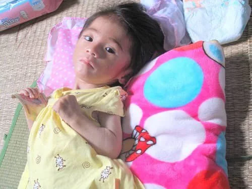 Chẩn đoán bại não thể co cứng