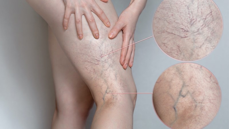 Giãn tĩnh mạch - triệu chứng, nguyên nhân và cách điều trị