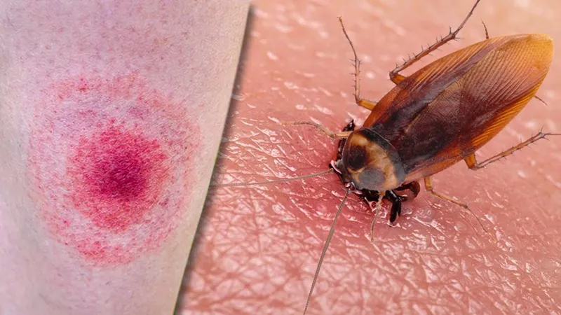 Bị gián cắn có ảnh hưởng gì?