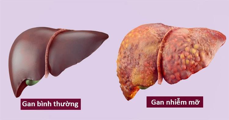 Gan nhiễm mỡ cấp độ 1 có nguy hiểm không? Dấu hiệu nhận biết và cách phòng ngừa hiệu quả
