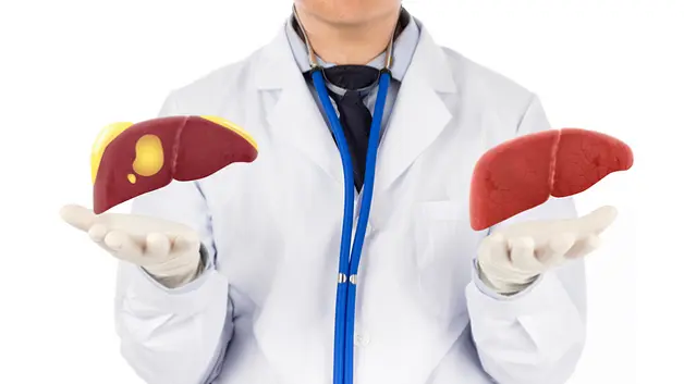 Gan nhiễm mỡ có lây không? Cách điều trị gan nhiễm mỡ