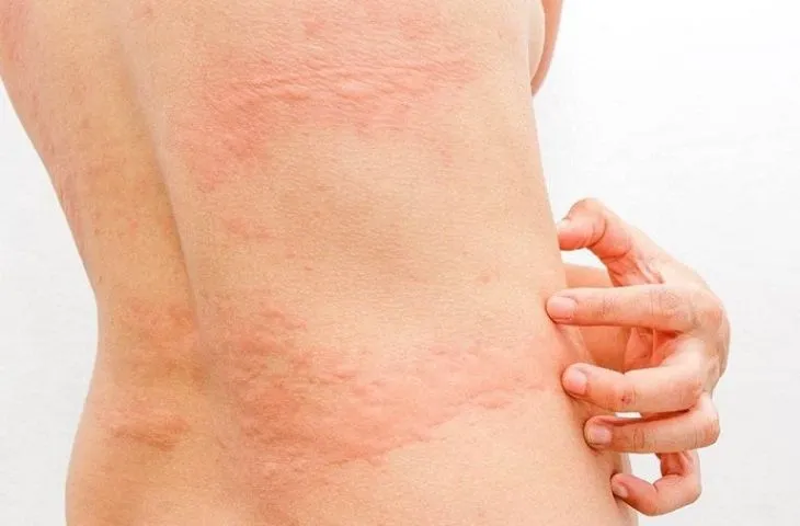 Trẻ bị nóng trong mẩn ngứa là do những nguyên nhân gì?