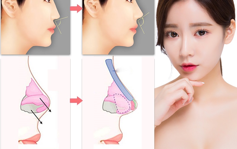 Nâng mũi ăn măng: những lưu ý quan trọng