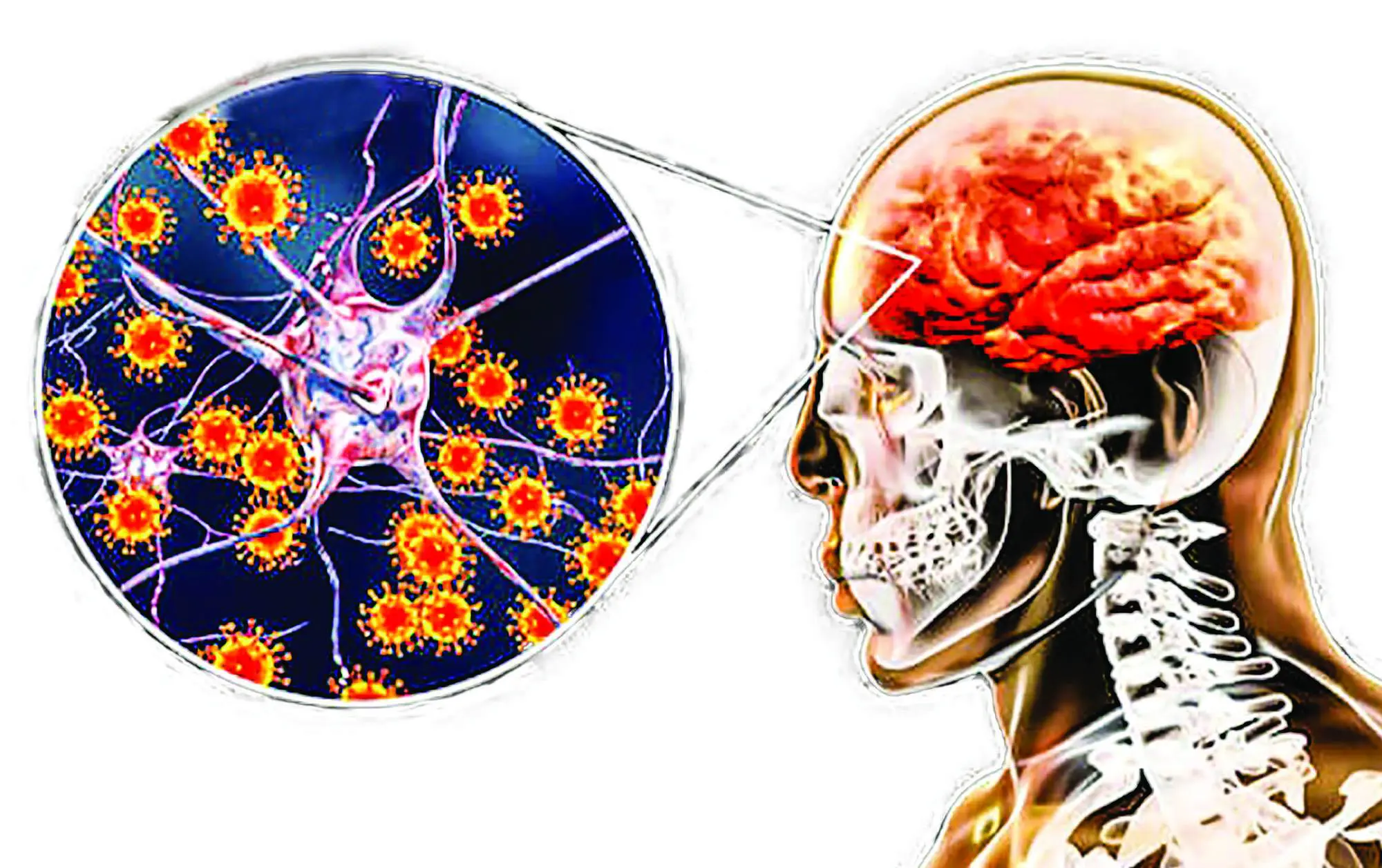 Di chứng nặng nề của viêm não Nhật Bản nếu không điều trị kịp thời