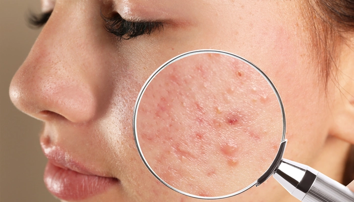Mụn Trứng Cá Là Gì? Nguyên Nhân, Triệu Chứng Và Cách Điều Trị Hiệu Quả
