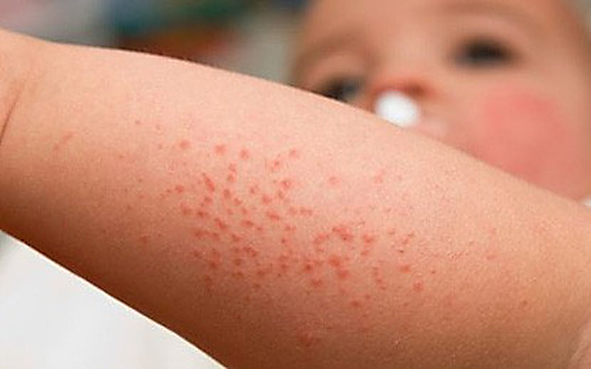 Khỏi sốt xuất huyết bao lâu thì được tắm? Những lưu ý khi tắm