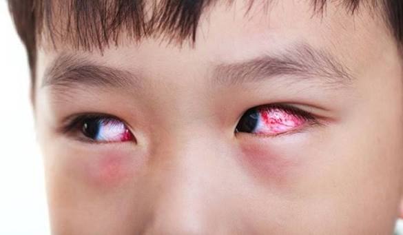 Mắt trẻ bị đỏ lòng trắng: Nguyên nhân thường gặp và cách xử trí cha mẹ cần biết