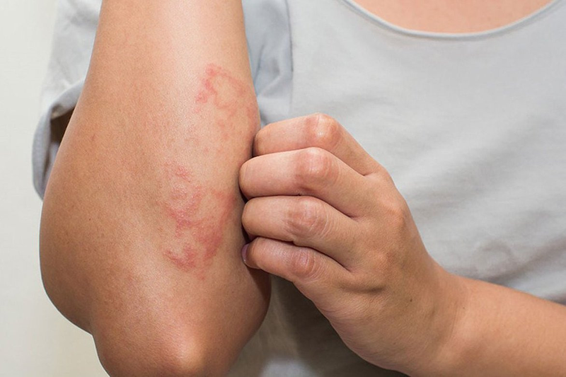 Cách xử lý vết côn trùng cắn sưng đỏ ngứa tại nhà