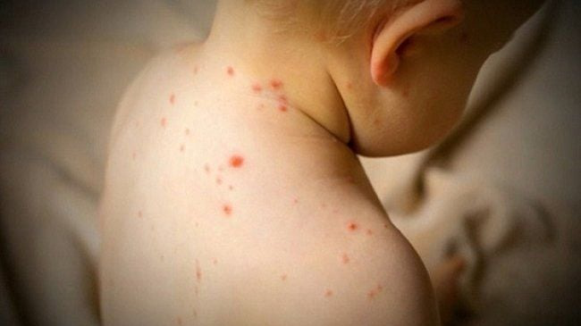 Hình ảnh bệnh sởi ở trẻ em: Phân biệt​ qua từng giai đoạn