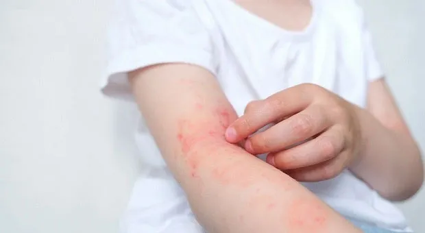 Mẩn ngứa vào ngày hè oi nóng và cách xử trí