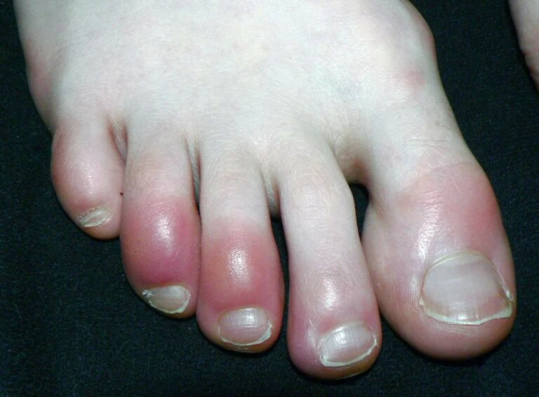 Bệnh cước (Chilblains): nguyên nhân, điều trị và phòng ngừa