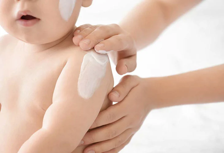 Gợi ý cho mẹ cách trị nổi mề đay tại nhà cho trẻ nhanh chóng