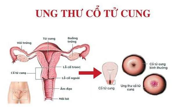 Độ tuổi nào phụ nữ cần tầm soát ung thư cổ tử cung?