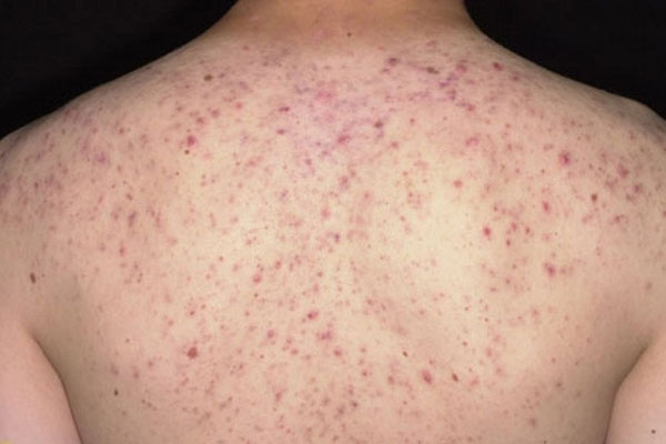 Mụn Ở Tuổi Dậy Thì: Nguyên Nhân Và Cách Điều Trị