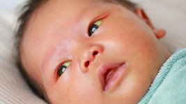 Phương pháp đánh giá mức độ vàng da sơ sinh và biện pháp phòng ngừa vàng da cho bé