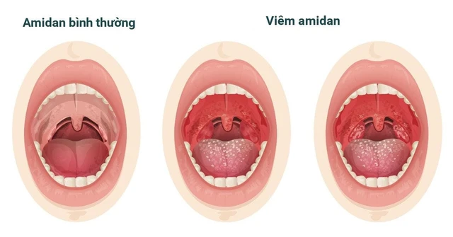 5 triệu chứng viêm amidan thường gặp và cách cải thiện