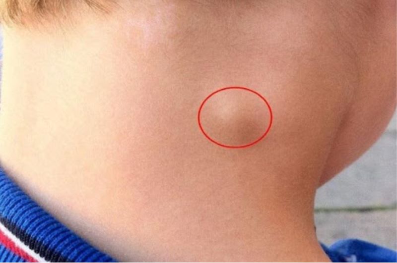 Cách chăm sóc bệnh nhân ung thư hạch tại nhà