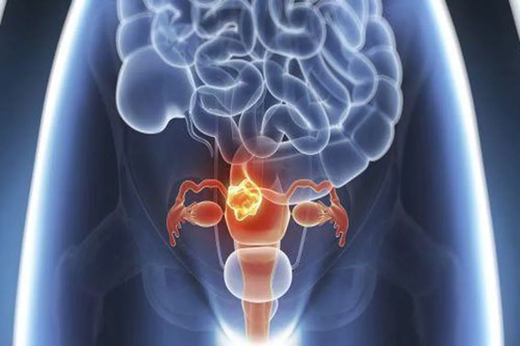 Bác sĩ chia sẻ phương pháp tự nhiên điều trị hội chứng buồng trứng đa nang gây hiếm muộn