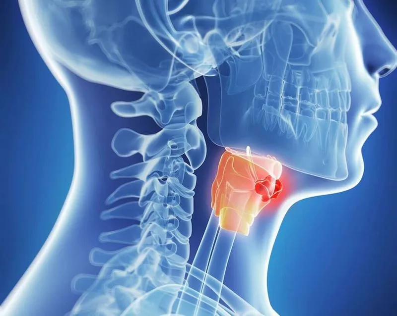 UNG THƯ HẠ HỌNG: NGUYÊN NHÂN, CÁCH CHẨN ĐOÁN VÀ ĐIỀU TRỊ