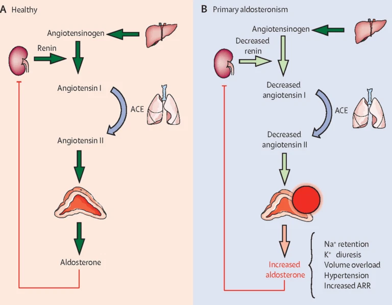 Bệnh cường aldosterone nguyên phát: nguyên nhân, triệu chứng và cách điều trị