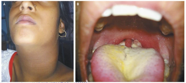 Bệnh bạch hầu: Nhận biết sớm để điều trị và phòng tránh