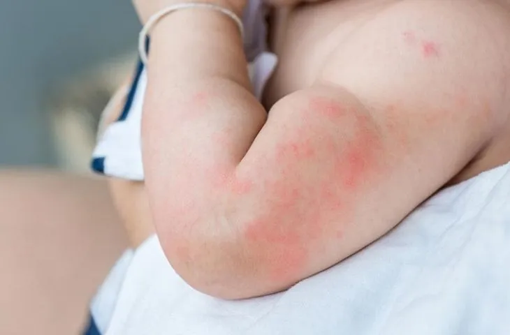 Viêm da tiếp xúc ở trẻ: Biểu hiện, nguyên nhân, cách phòng tránh và điều trị