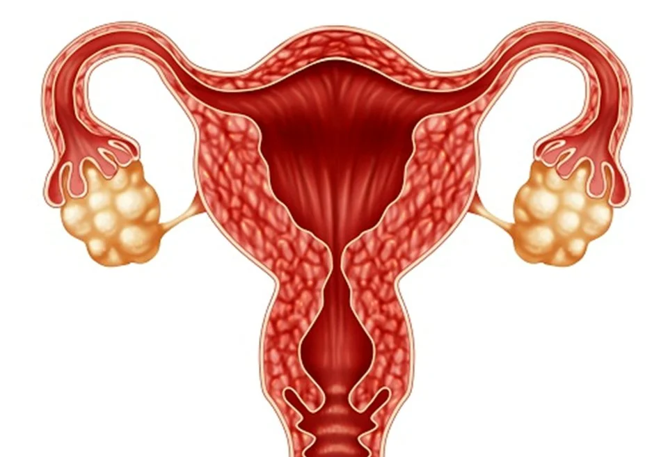 Nhiều người không biết mình mắc đa nang buồng trứng