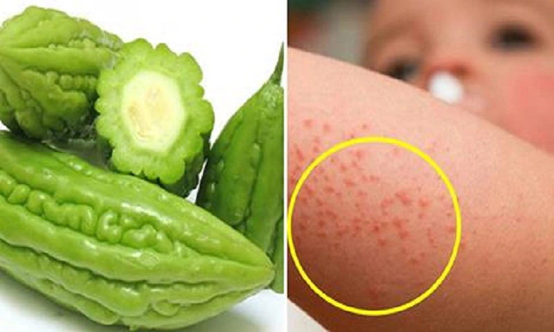 Trị rôm sảy ở trẻ trong mùa hè thế nào?