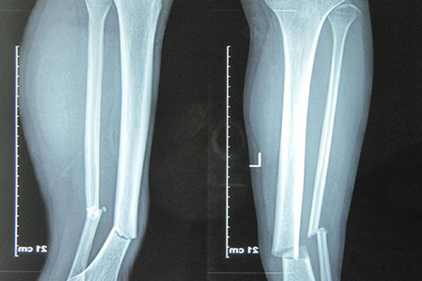 Chậm liền xương: Nguyên nhân, dấu hiệu và cách thúc đẩy quá trình liền xương