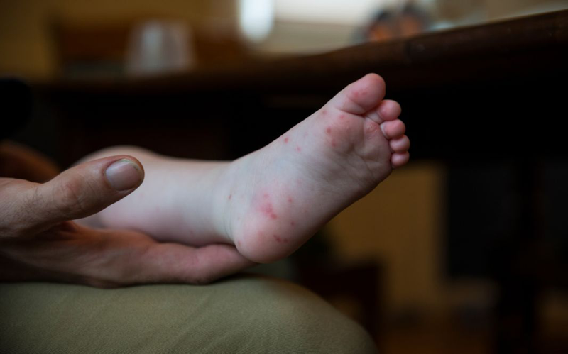 Trẻ bị tay chân miệng có lây cho người lớn​ không?