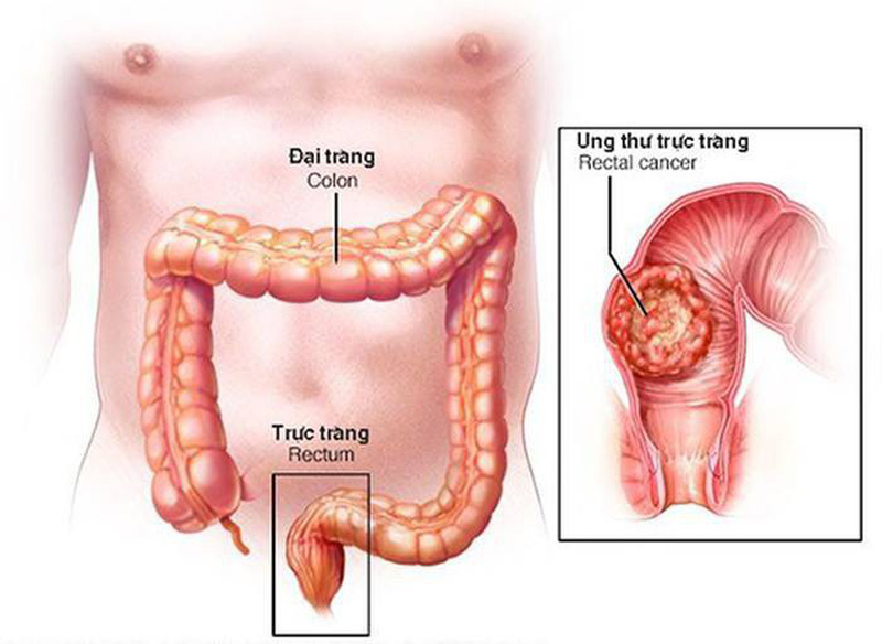 Phát hiện sớm ung thư trực tràng: Những dấu hiệu không thể bỏ qua
