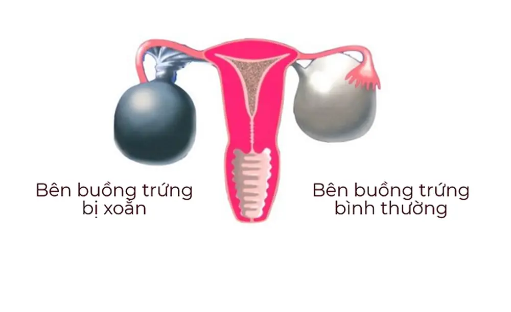 6 nguyên nhân gây đau tại buồng trứng