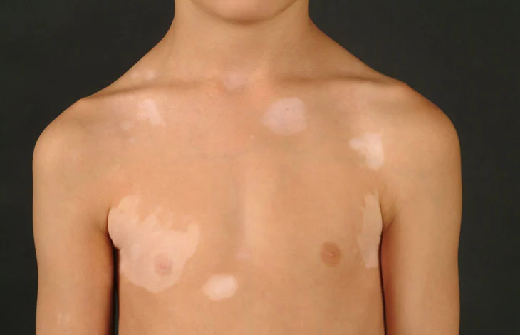 Bệnh lang ben: bệnh lý da liễu thường gặp