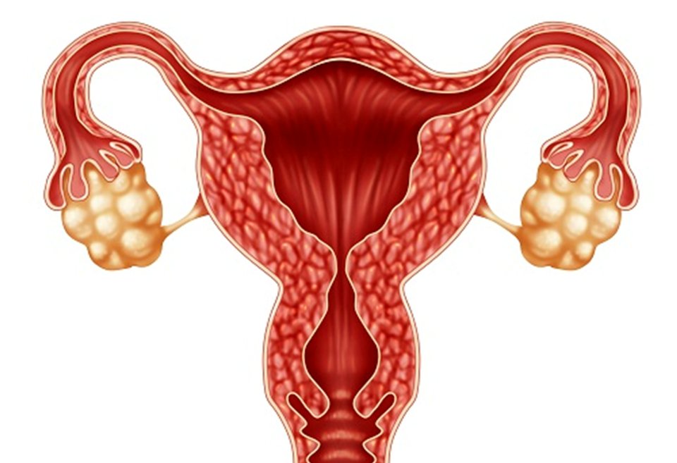 Bệnh buồng trứng đa nang và những thông tin cần lưu ý.