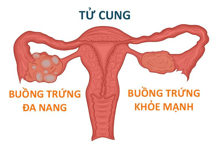 Hội chứng buồng trứng đa nang: chẩn đoán và điều trị như thế nào?