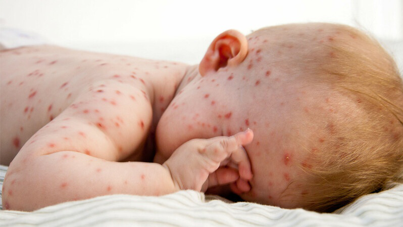 Các bệnh lý thường gặp ở trẻ em bố mẹ nên biết để phòng ngừa